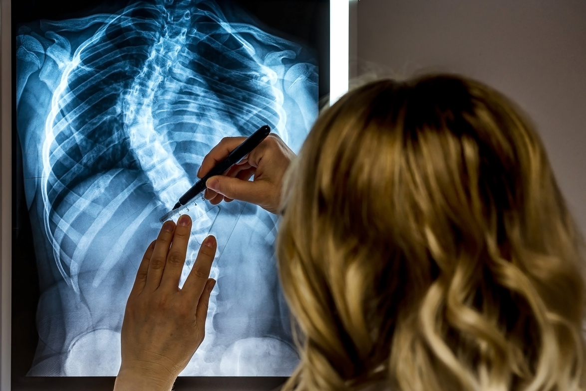 Scoliosis specialist Doctor with patients X-Ray